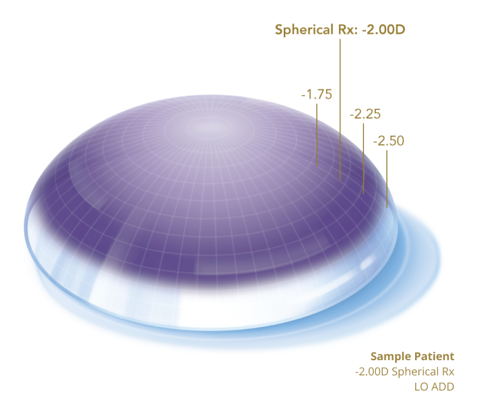 Profile view of sample patient's eye showing a Spherical Rx of -2.00D and LO ADD