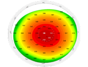 A corneal topography map displaying color-coded data with red, yellow, and green zones, illustrating variations in corneal curvature and elevation for diagnostic purposes.