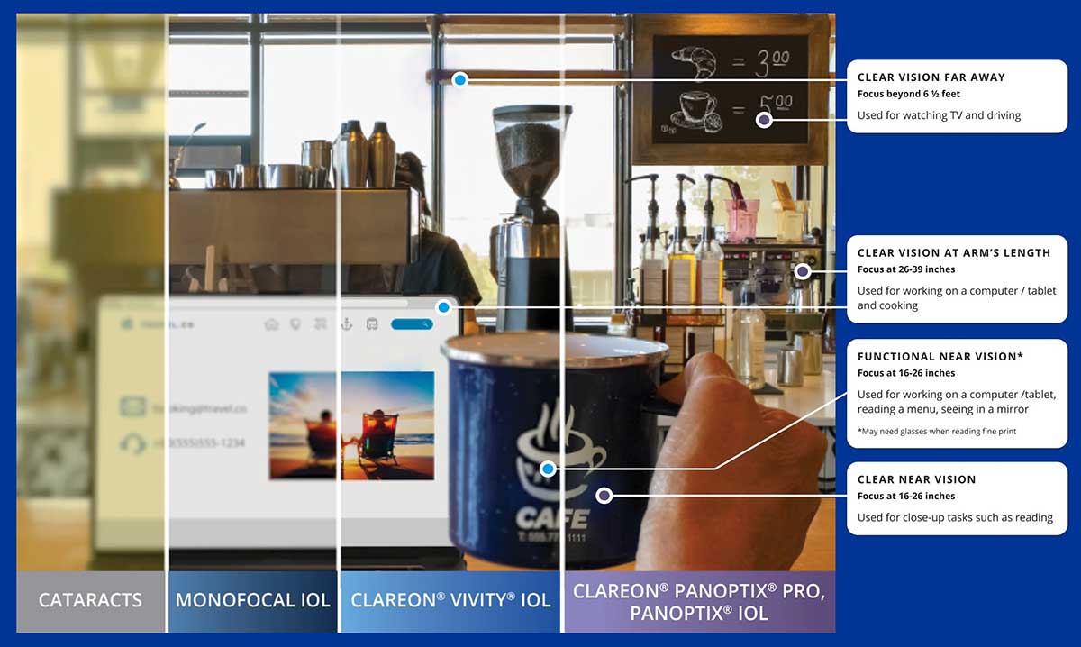 Comparison of cataracts, monofocal, Vivity, and PanOptix lenses showing differences in distance, intermediate, and near vision clarity during the daytime.
